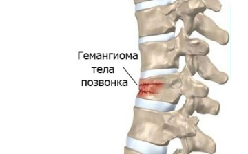 Просмотр темы - Перескочил ГРМ на Подкожный прыщ! Помогите подкожные прыщи как шишки