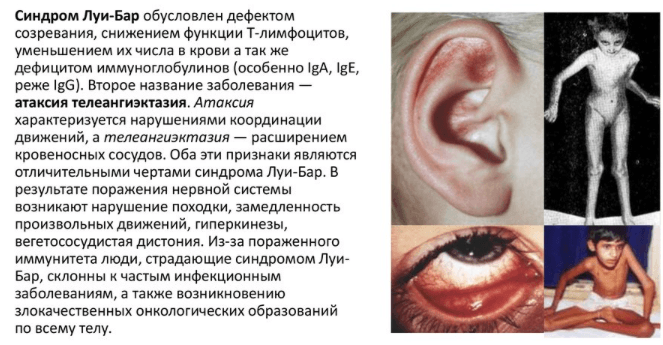 Синдром Луи-Бар Синдром Луи-Бар