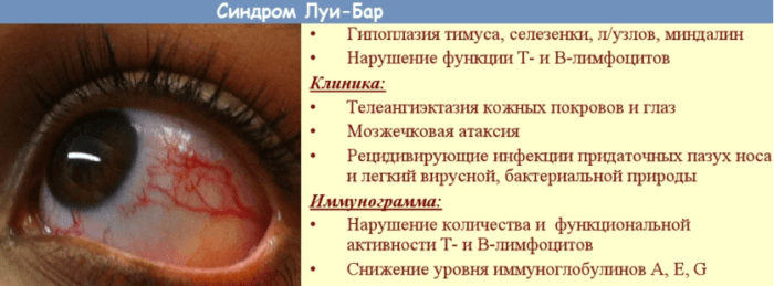 Синдром Луи-Бар Синдром Луи-Бар