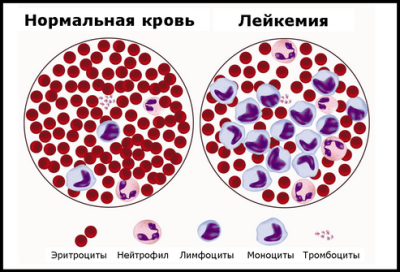 лейкоз крови