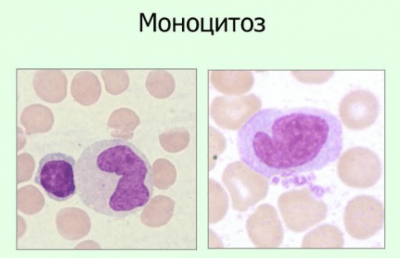 Моноциты в анализе крови повышены при беременности