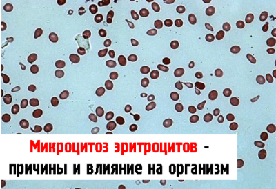 Изменение формы эритроцитов. Микроциты повышены что это. Микроциты повышены что это. Микроциты повышены что это. Микроцитоз характерен для анемии.