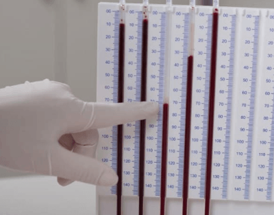 Железодефицитная анемия анализ крови показатели