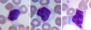 Характеристика крови при железодефицитной анемии
