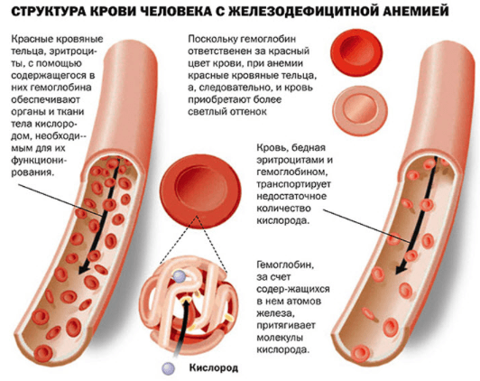Какие изменения в анализе крови при анемии