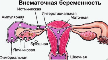 Розовые выделения во время менструации