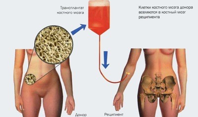 Сандиммун неорал апластическая анемия