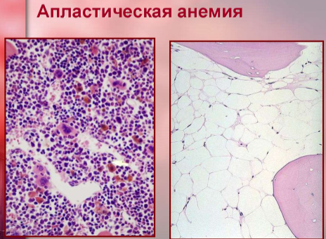 Сандиммун неорал апластическая анемия