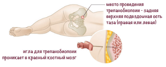 Сандиммун неорал апластическая анемия