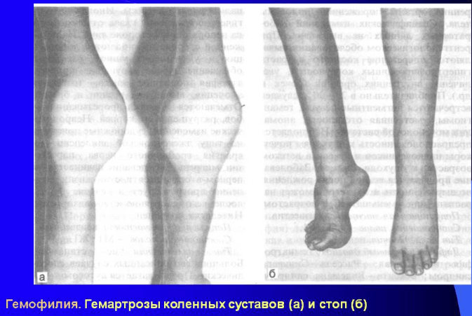 Показатели анализа крови при гемофилии