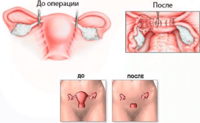 Что делать если есть кровотечение после прижигания эрозии