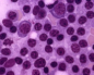 Лейкоцитоз и лимфопения в анализе крови thumbnail