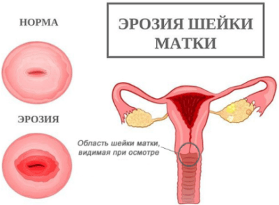 Розовые выделения при менструации